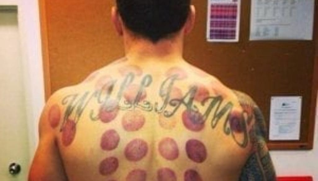 sonny_bill_williams_has_cupping_therapy_N2