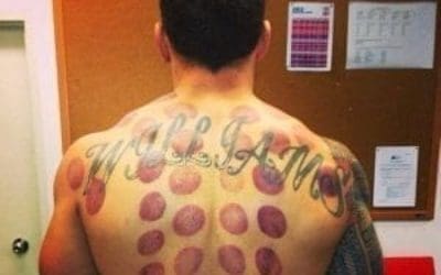 sonny_bill_williams_has_cupping_therapy_N2