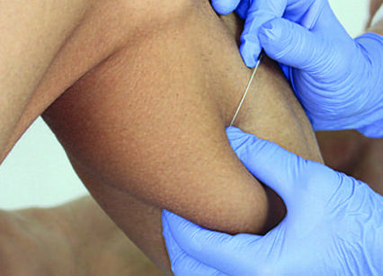 Dry Needling 3