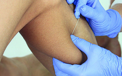 Formation Dry Needling perfectionnement – Quadrant Inférieur