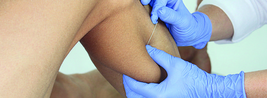 Dry Needling perfectionnement – quadrant supérieur (15-17 Décembre 2024) Lille