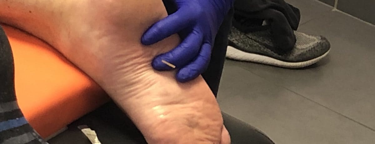 Perfectionnement Dry Needling – Quadrant inférieur (13-15 Decembre 2026) Bouc Bel Air