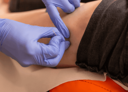 formaiton kiné dry needling