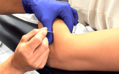 DRY NEEDLING QUANDRANT SUP DRY NEEDLING QUANDRANT SUP