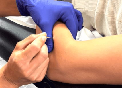 DRY NEEDLING QUANDRANT SUP