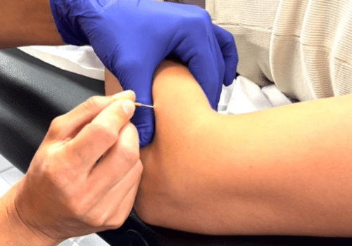 Formation Dry Needling perfectionnement – quadrant supérieur