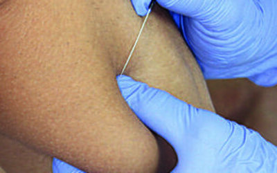Dry Needling 3