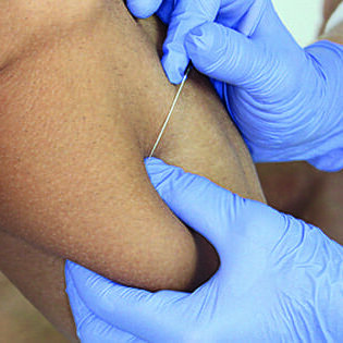 Dry Needling Perfectionnement (6-8 Décembre 2026) Lille