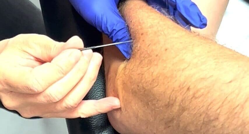 Dry Needling perfectionnement – quadrant supérieur (6-8 Décembre 2026) Lille