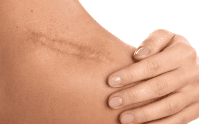 formation kiné Traitement des Cicatrices kiné