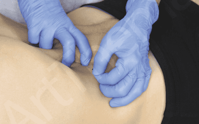 Formation Douleurs Pelvi-périnéales - Dry Needling (Nouvelle Formation)