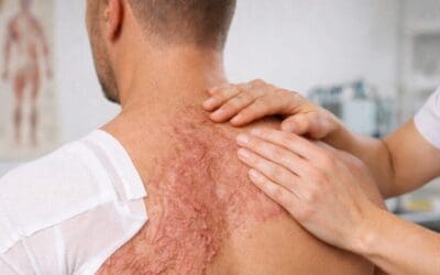 Formation Brûlures, grands brûlés - Stratégie thérapeutique et traitement (nouvelle formation)