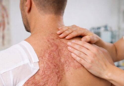 Formation Brûlures, grands brûlés – Stratégie thérapeutique et traitement (nouvelle formation)