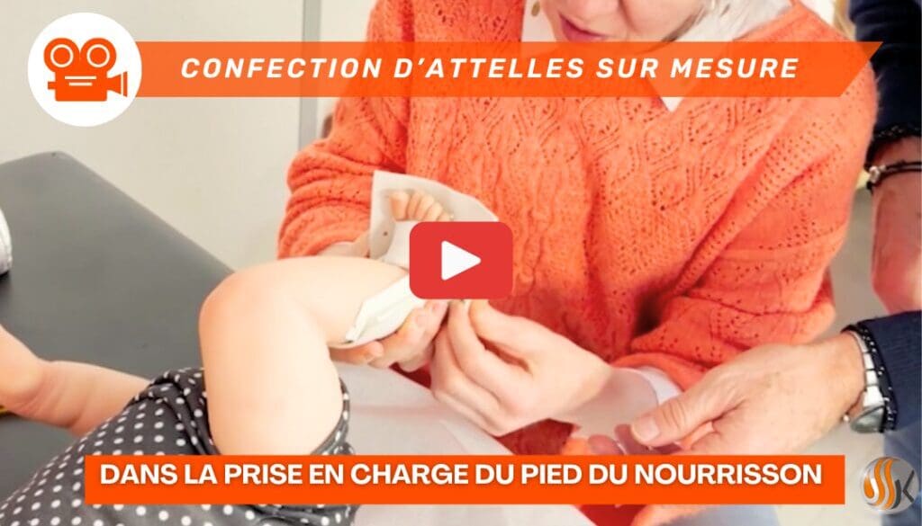 L’Art de l’Attelle sur Mesure dans la Prise en Charge du Pied du Nourrisson (vidéo)